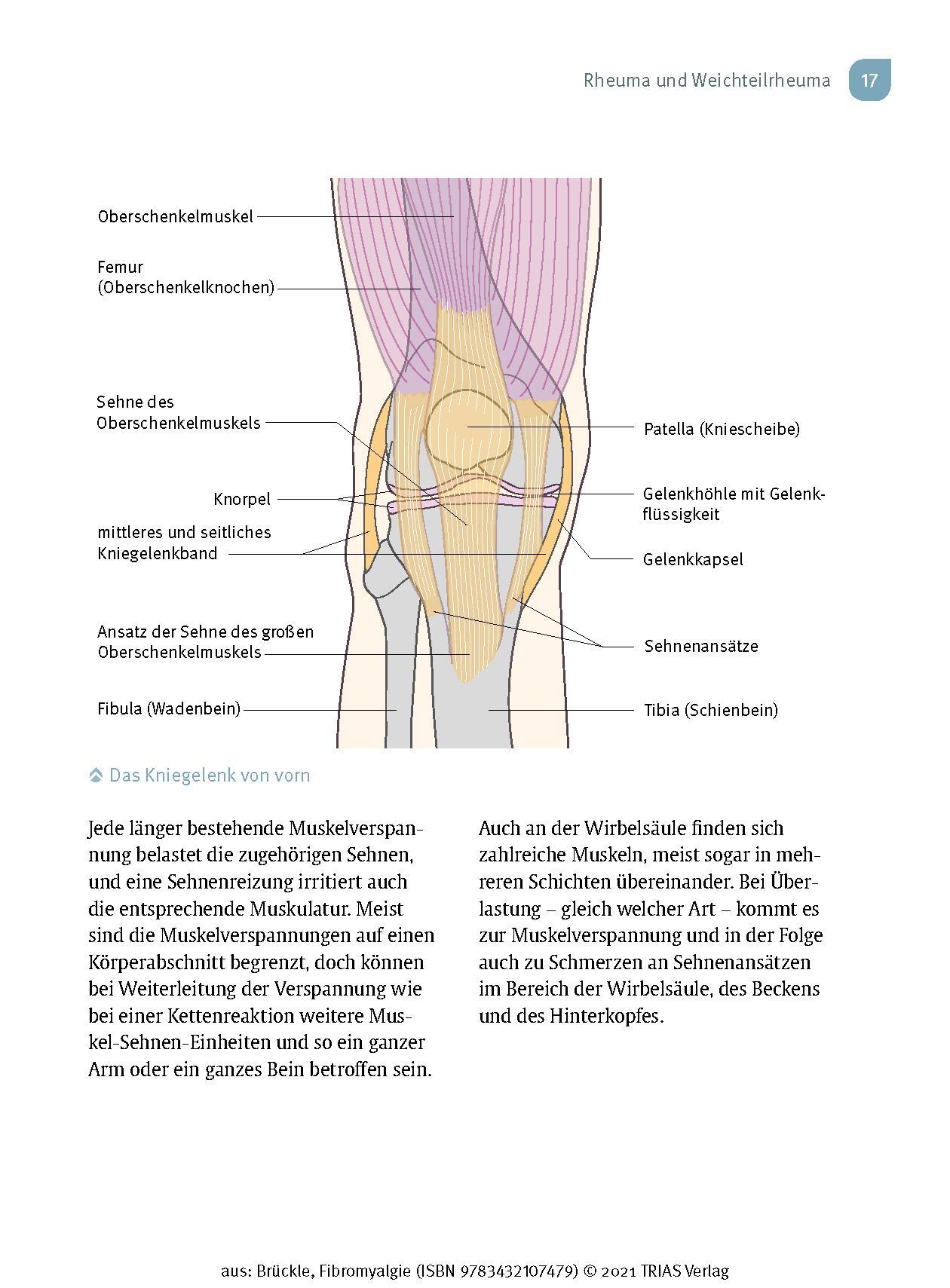 Fibromyalgie