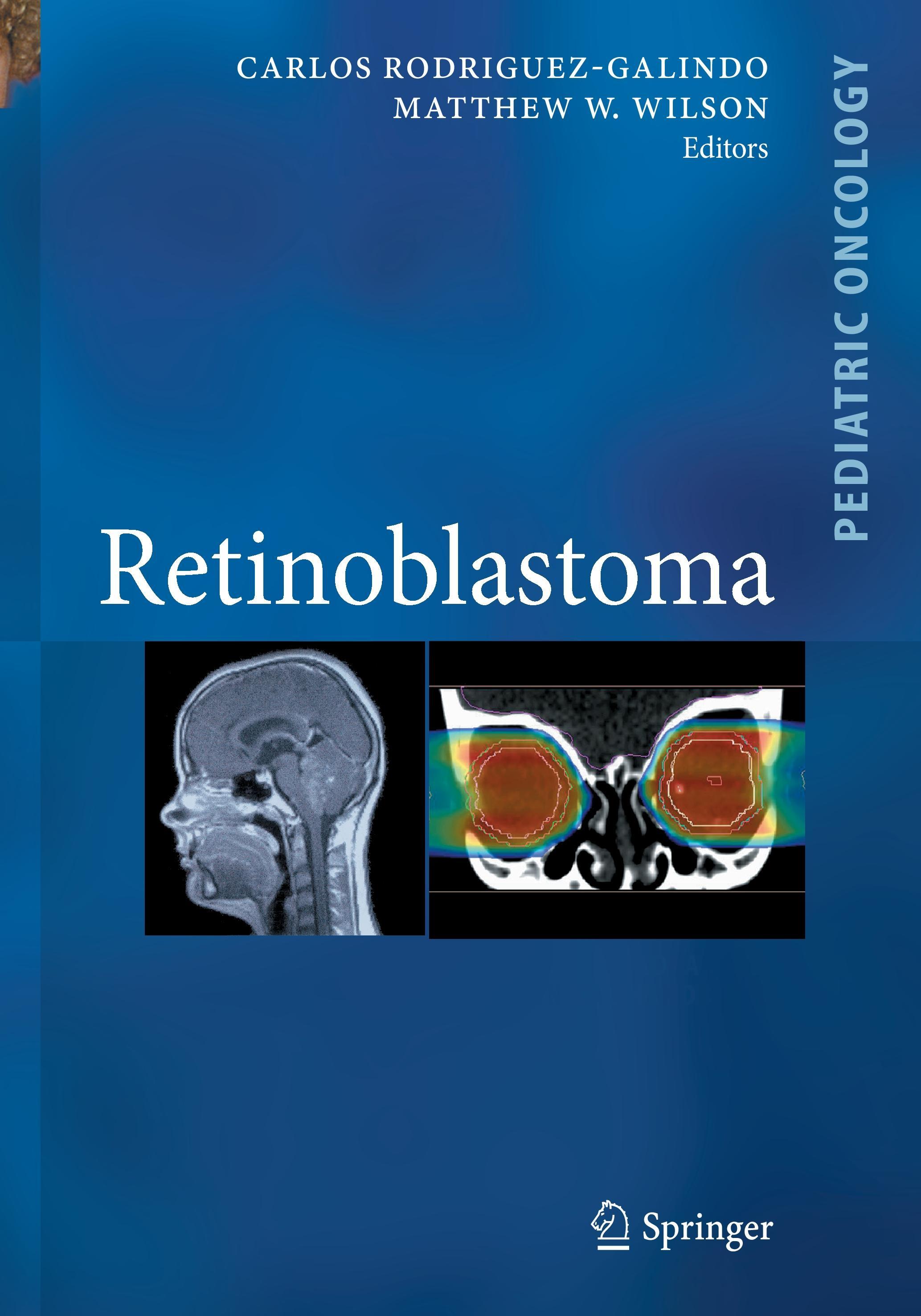 Retinoblastoma